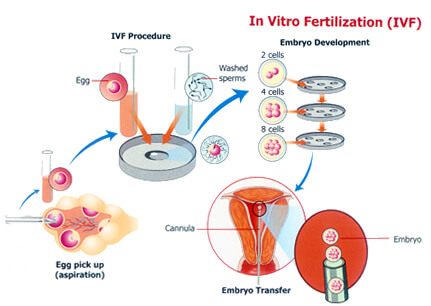 IVF Process in Delhi
