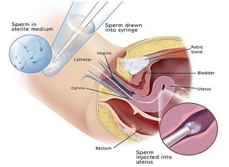 IUI Treatment in Delhi IUI Treatment in Delhi