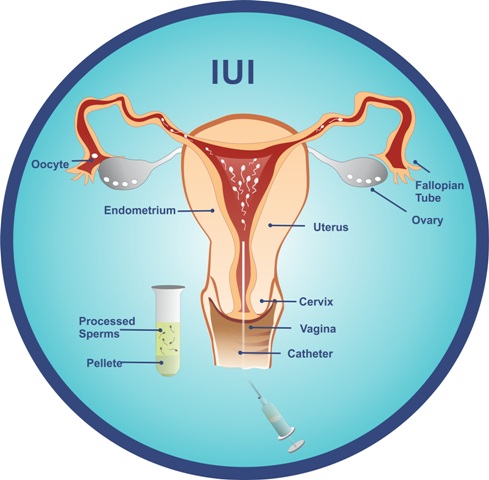 IUI treatment in Chennai IUI treatment in Chennai