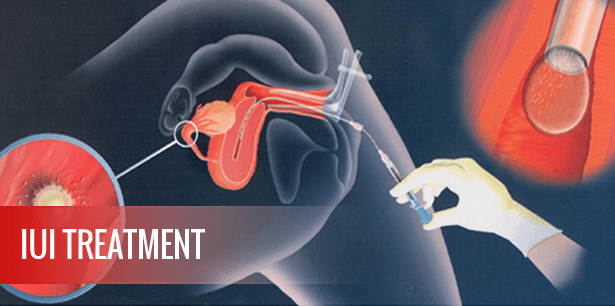 IUI Treatment in Bangalore IUI Treatment in Bangalore
