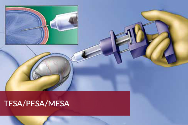 MESA treatment in India