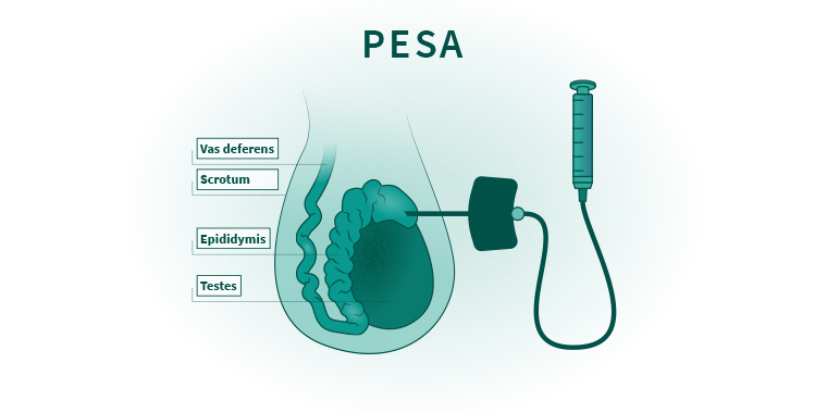 PESA Treatment in india