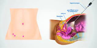 Laparoscopic surgery in Mumbai