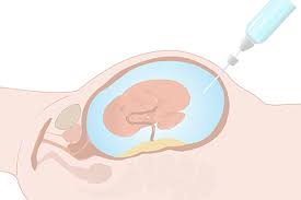 Amniocentesis Test in India