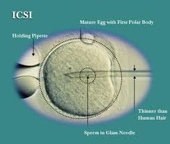 ICSI Treatment in Chennai