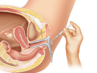 IUI Treatment in Chennai
